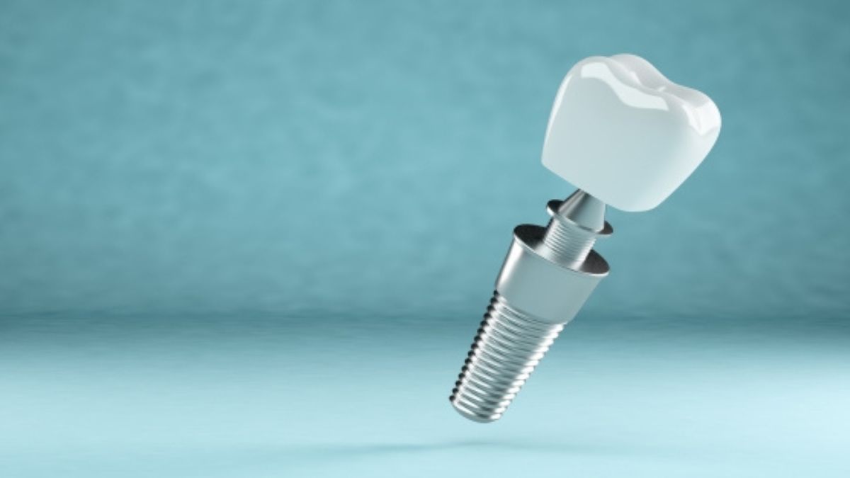 The Advantages of Titanium Alloy Dental Implants for Long-Lasting Results